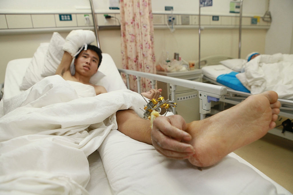 A patient in a hospital bed with his severed hand attached to his leg for preservation