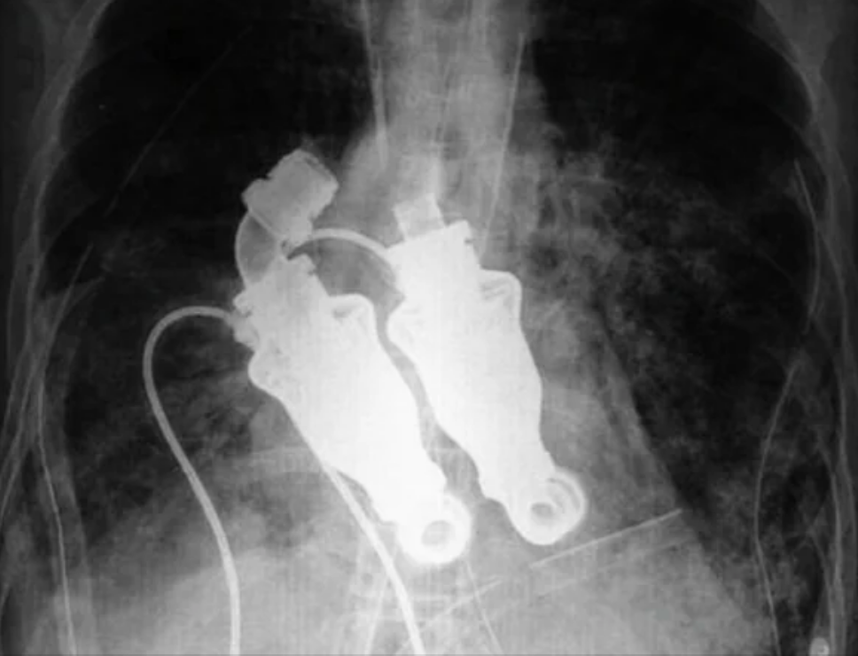 X-ray image showing two mechanical heart devices implanted in the chest cavity, connected with visible wires