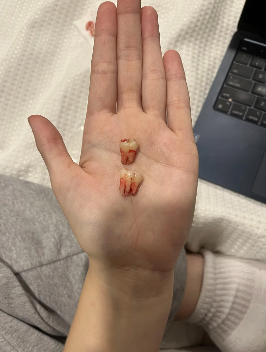 Two extracted teeth resting on an open palm. One has two roots, and the other has three
