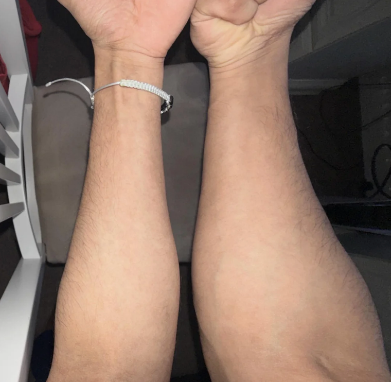 Two forearms with one much bigger and more muscled than the other