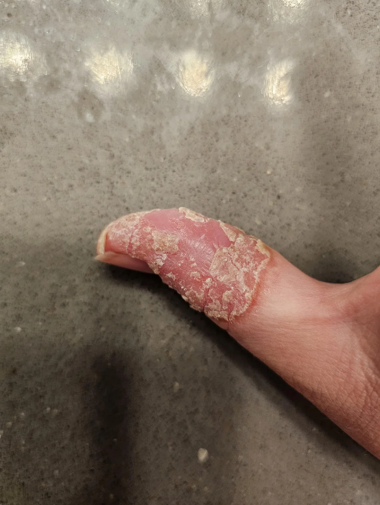 Close-up of a finger with cracked, peeling skin on the top half