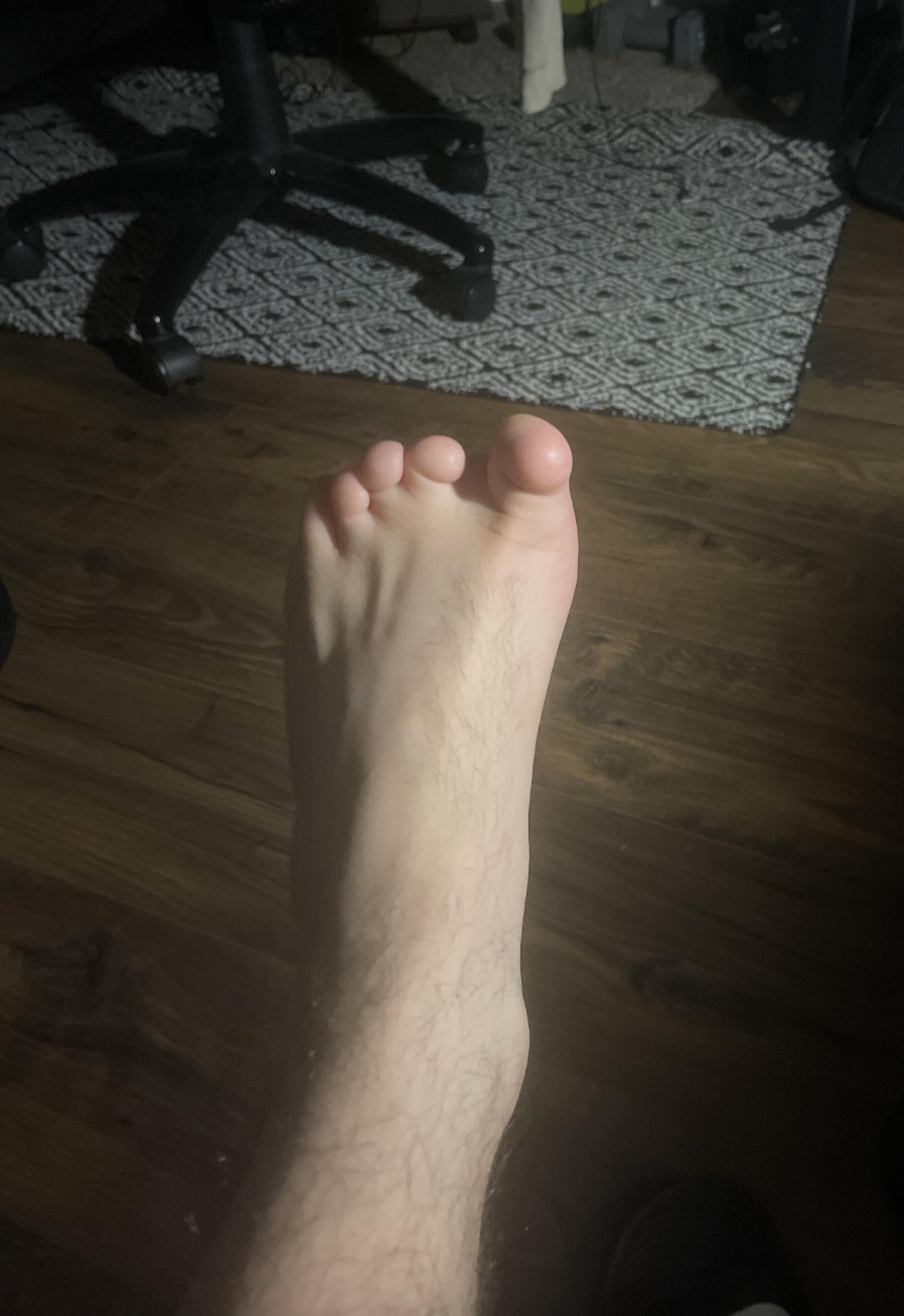A person's bare foot is extended; they have no toenails, and their toes seem to angle up