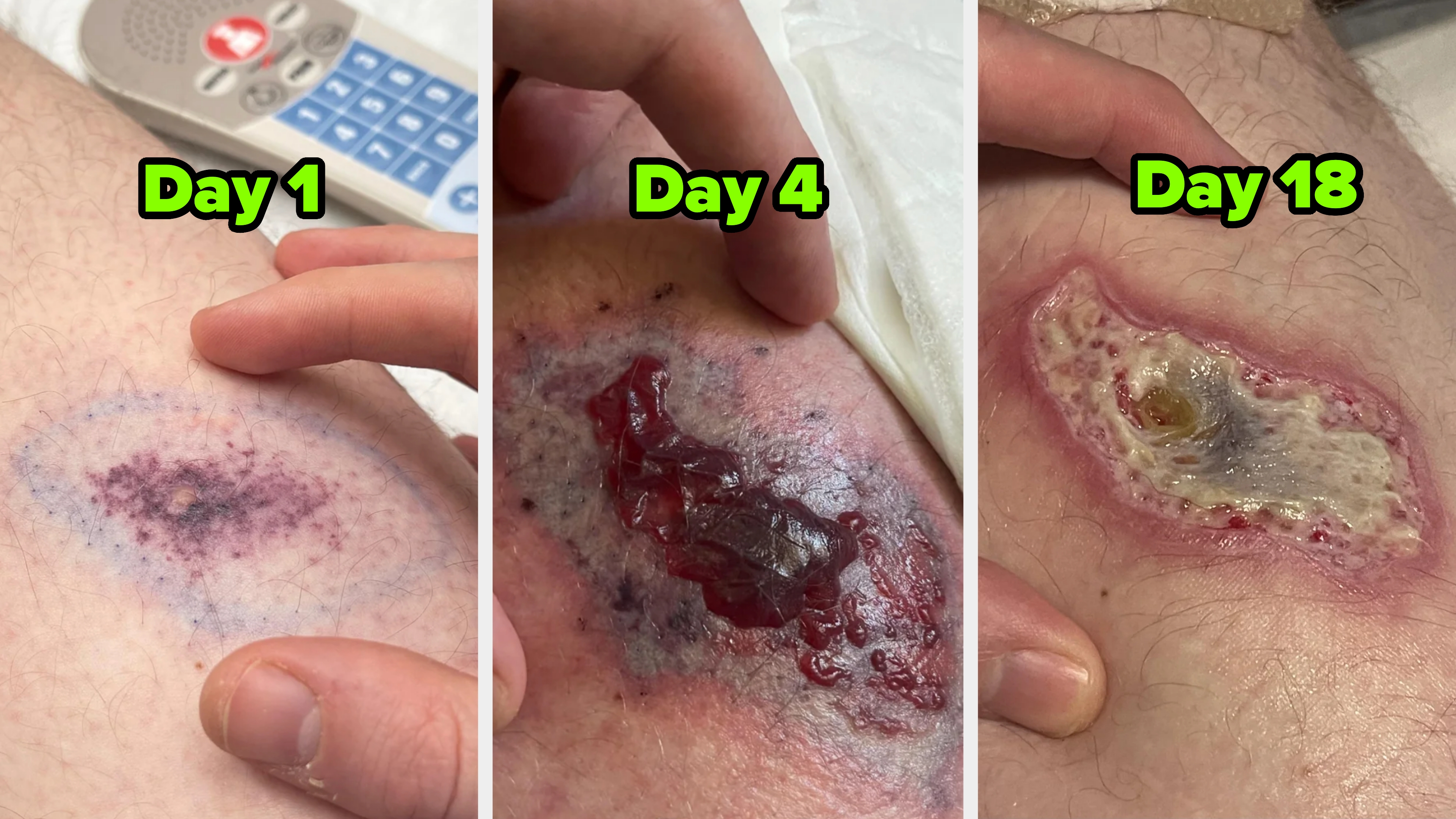 Three images show a worsening wound on a person's leg, progressing from a bruise to an open wound with a scab