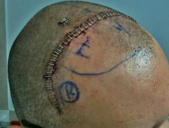 Close-up of a shaved head with a large scar crossing over the head, closed with surgical staples