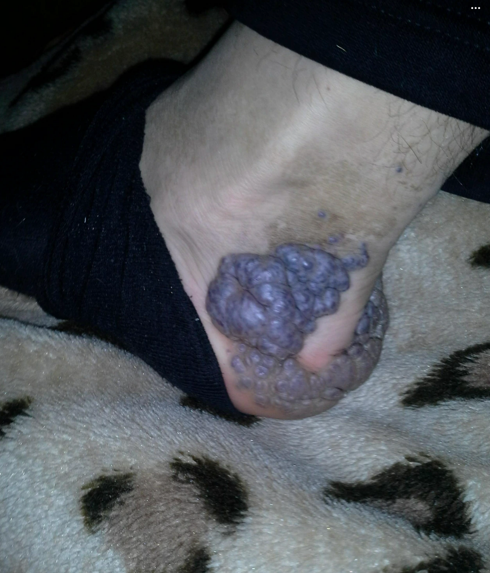 A foot with large purple bulbous growths on the heel