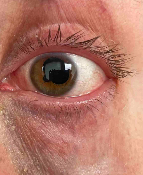 Close-up of a person's eye, with a large, irregularly shaped pupil