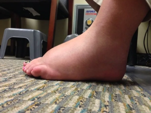 swollen foot