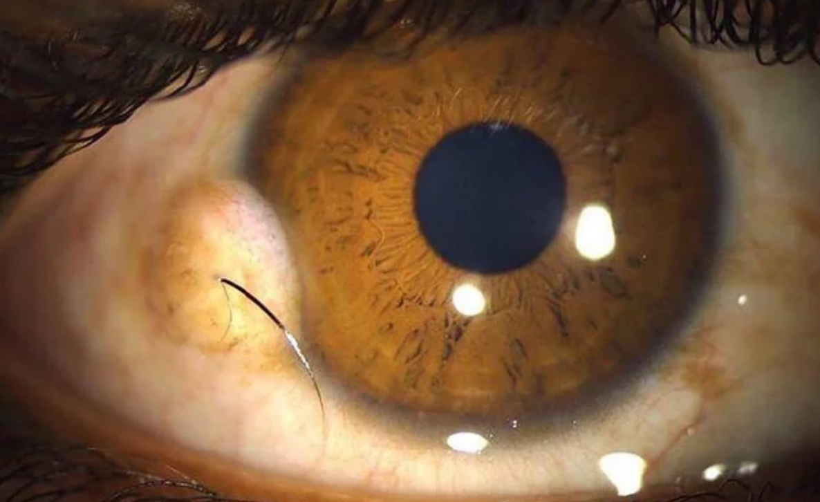 Close-up of a human eye with a small cyst next to the iris, with a hair growing out of it