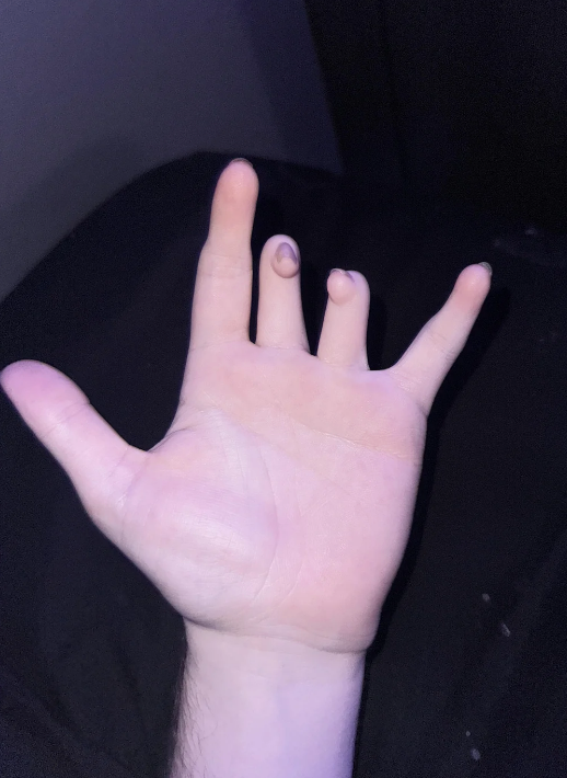 A person holds their hand up, with fingers spread apart. The middle and ring fingers are shorter and angle up. The pointer and pinky fingers are also slightly short and missing the third joint