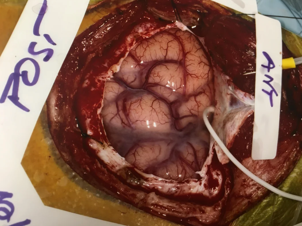 Medical image showing a human brain during surgery, exposed through a hole in the skull