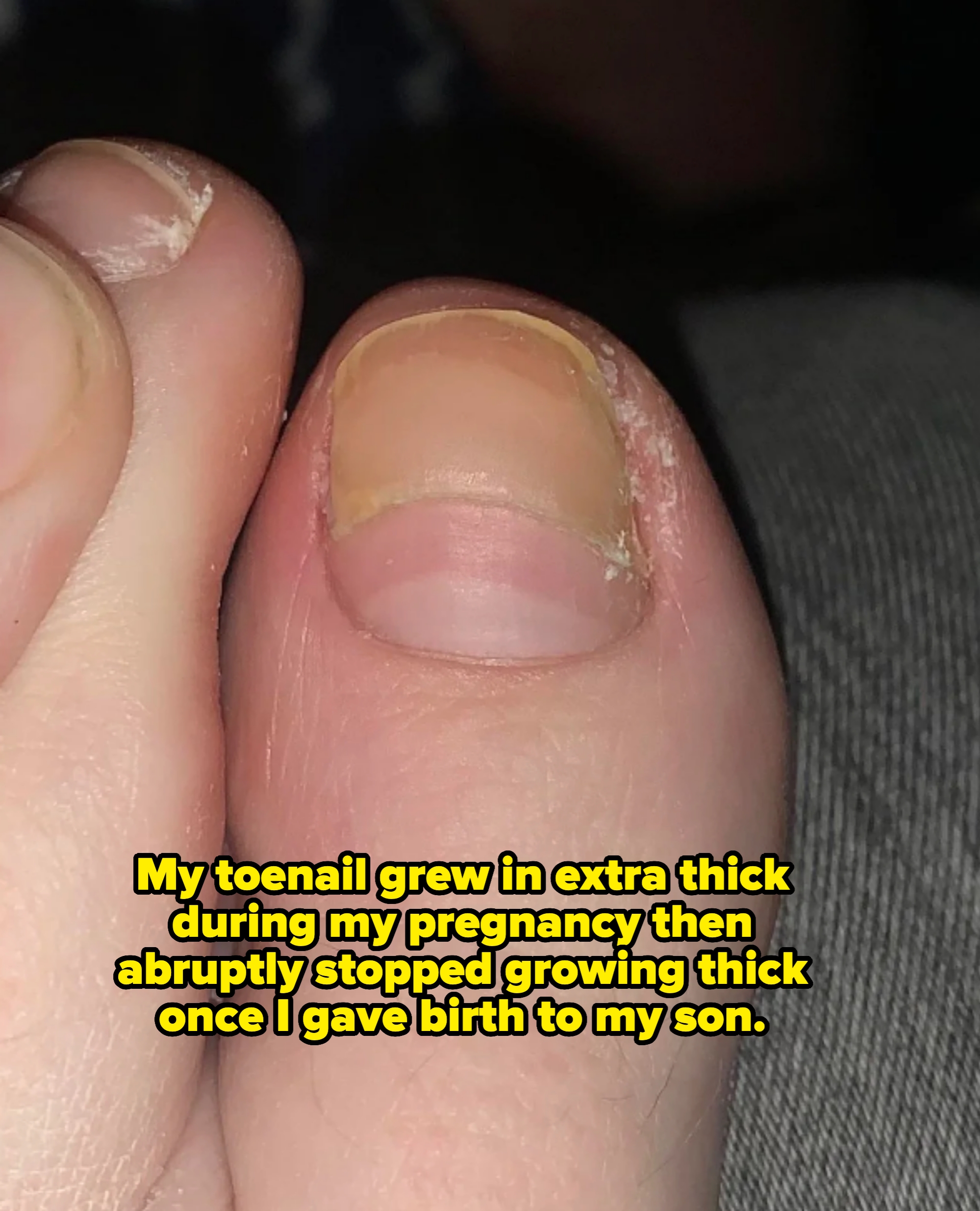 Close-up of a person's big toe showing overly thick nail that turns normal halfway down. Caption: "My toenail grew in extra thick during my pregnancy then abruptly stopped growing thick once I gave birth to my son"