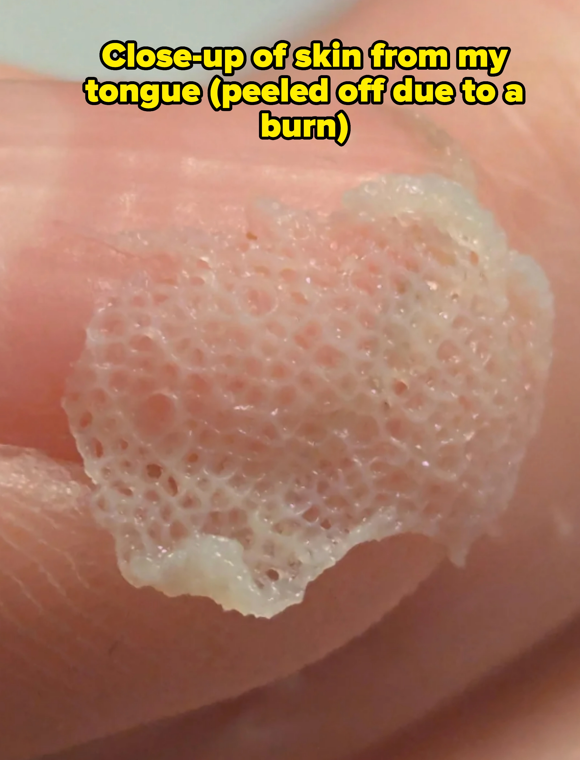 Close-up of a finger with a small piece of translucent, net-like material, captioned "Close-up of skin from my tongue (peeled off due to a burn)"