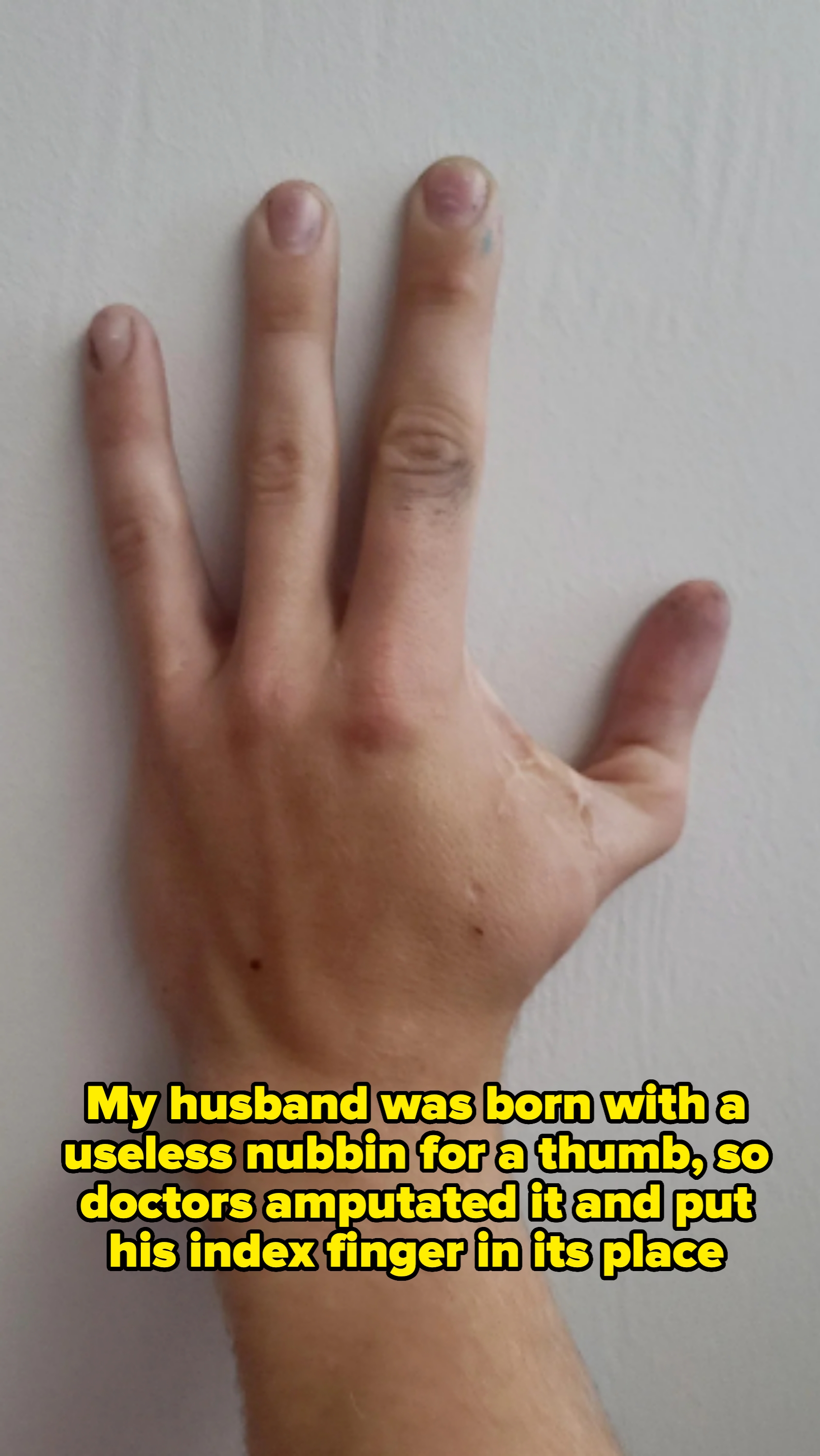 A hand with three fingers and a thumb, with scars at the base of the thumb. Caption: "My husband was born with a useless nubbin for a thumb, so doctors amputated it and put his index finger in its place"