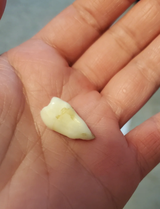 A hand holds a tooth with one fused root