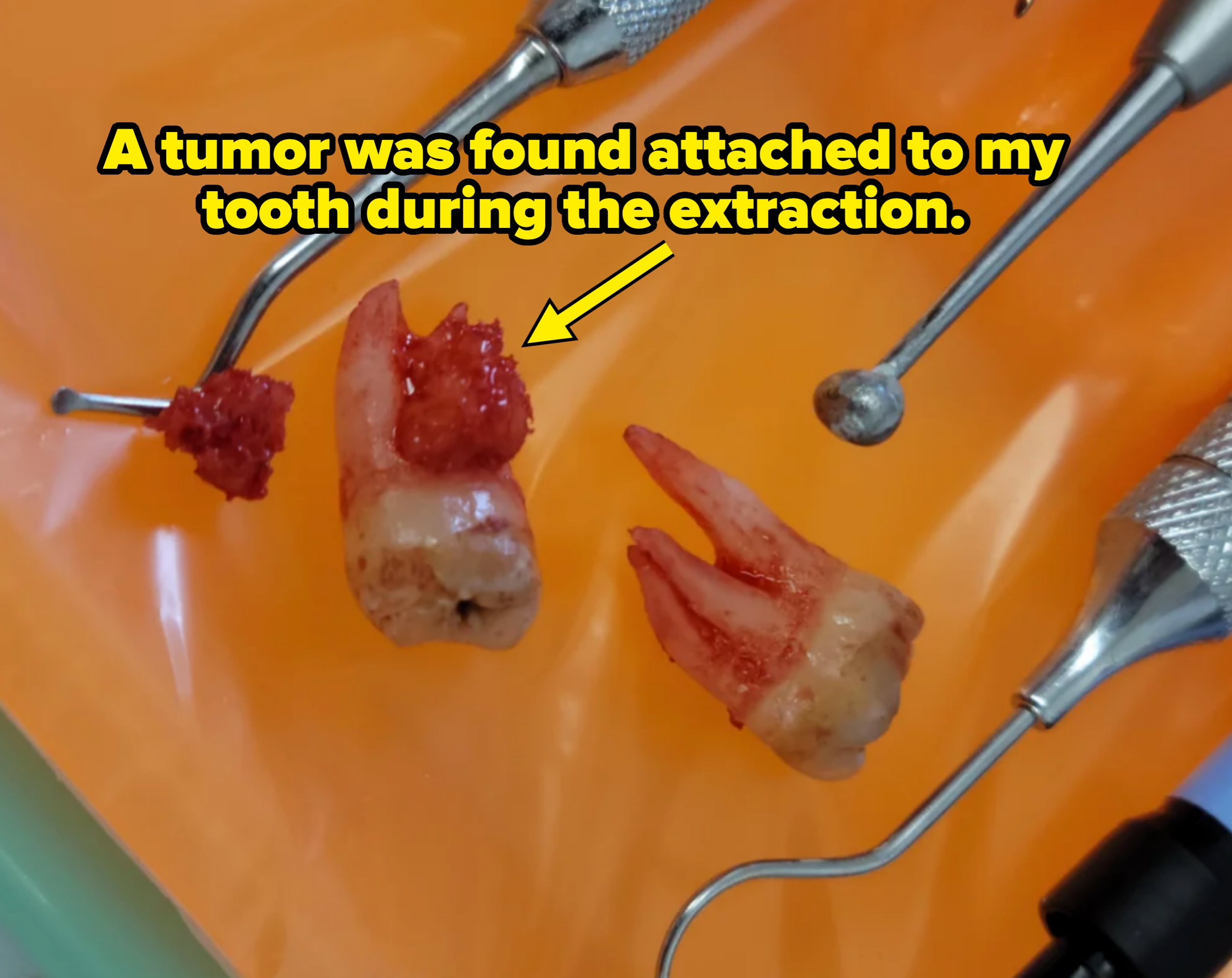 Two extracted teeth; one has a tumor on it