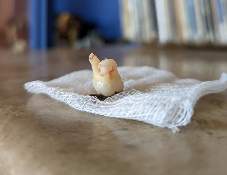 An extracted tooth sits on a piece of gauze on a smooth surface. One root is hooked