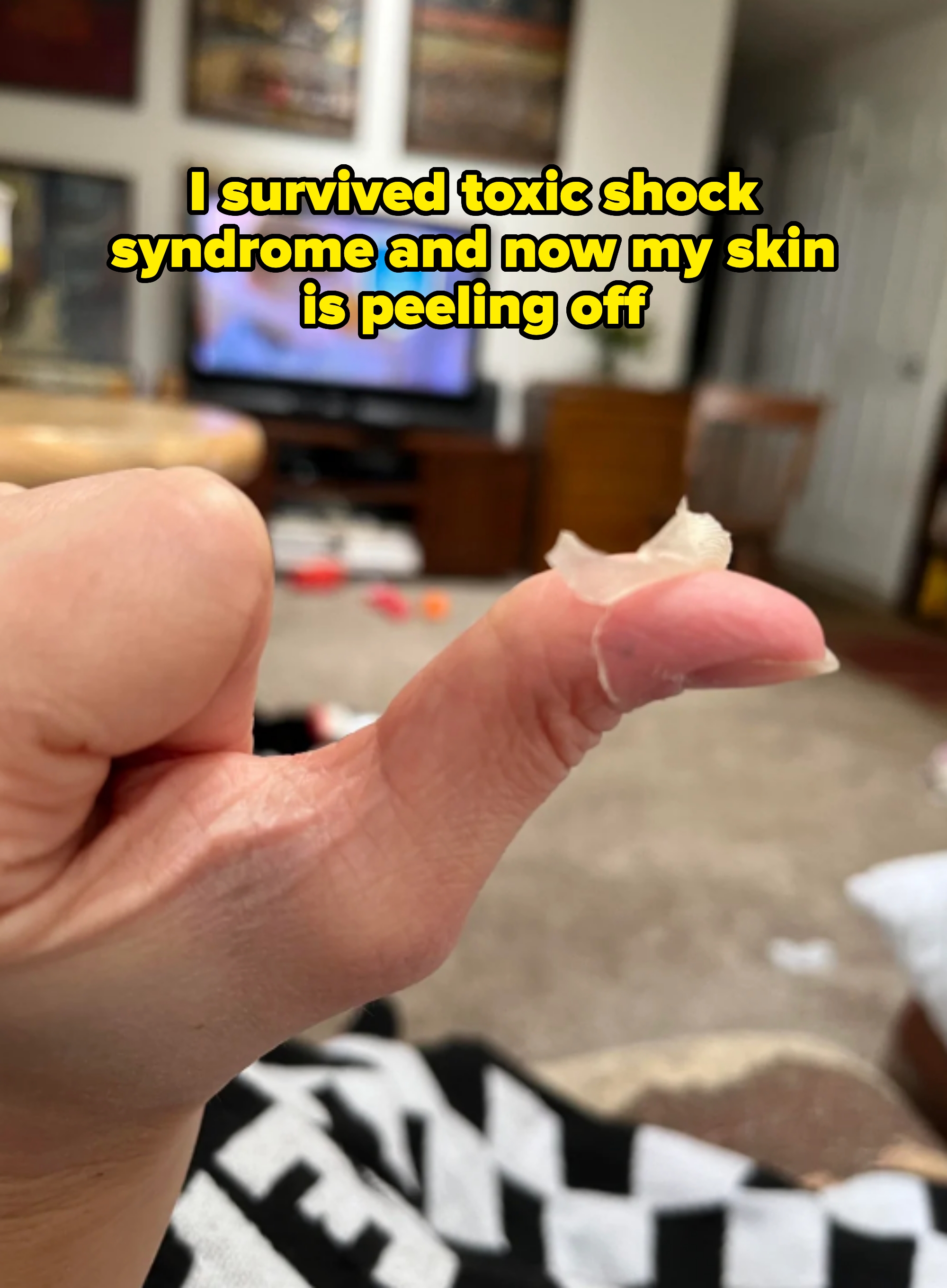 skin peeling on thumb captioned, "I survived toxic shock syndrome and now my skin is peeling off"