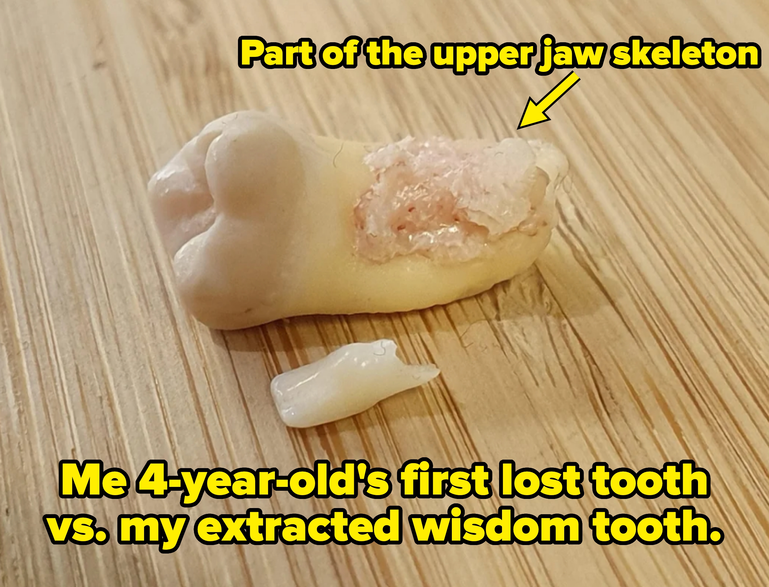 Large extracted wisdom tooth with part of the upper jaw skeleton in it vs. a much smaller baby tooth