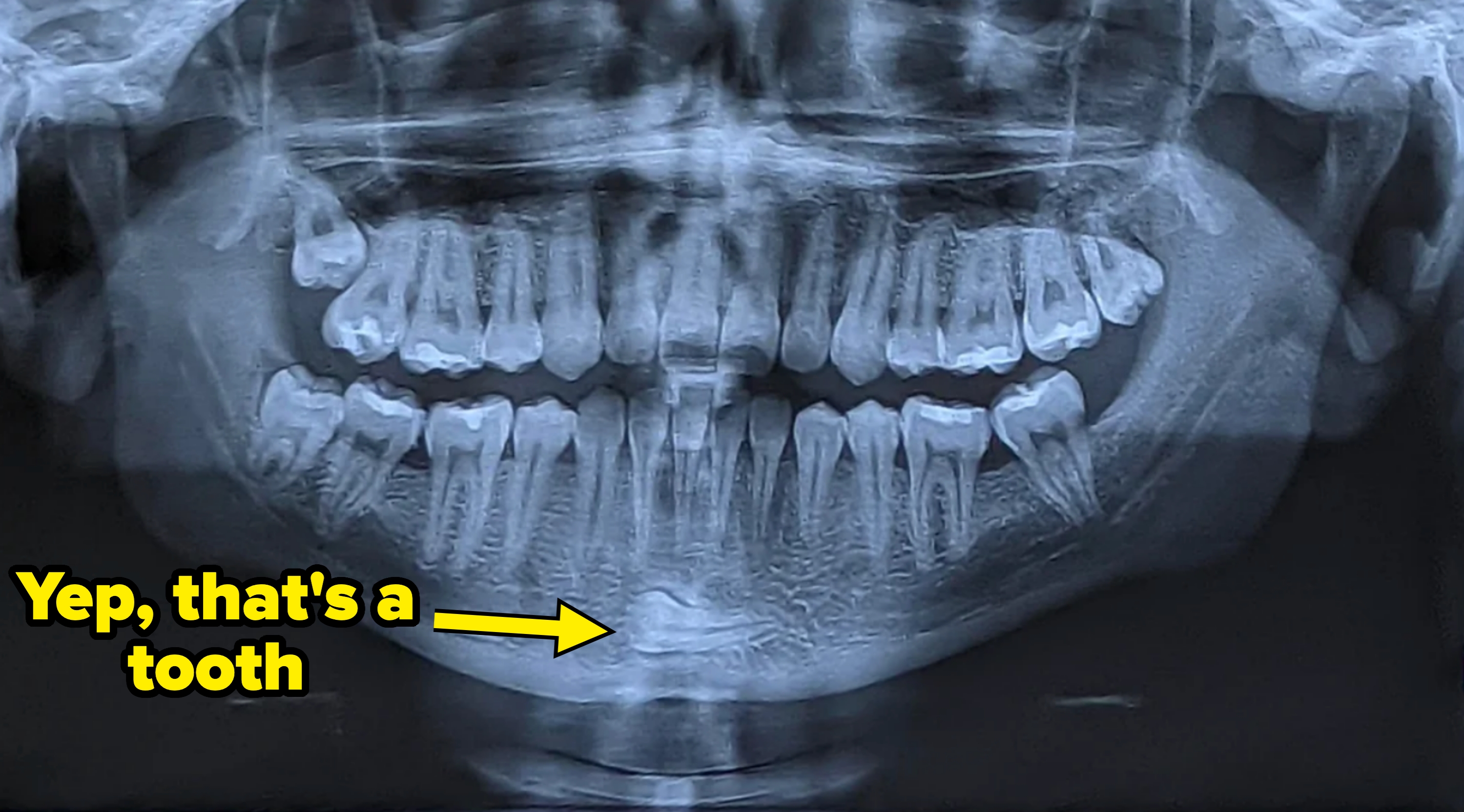 Dental X-ray showing a full set of adult teeth with visible roots and jaw structure; there is also a tooth in the lower jaw, underneath the bottom row of teeth, angled sideways