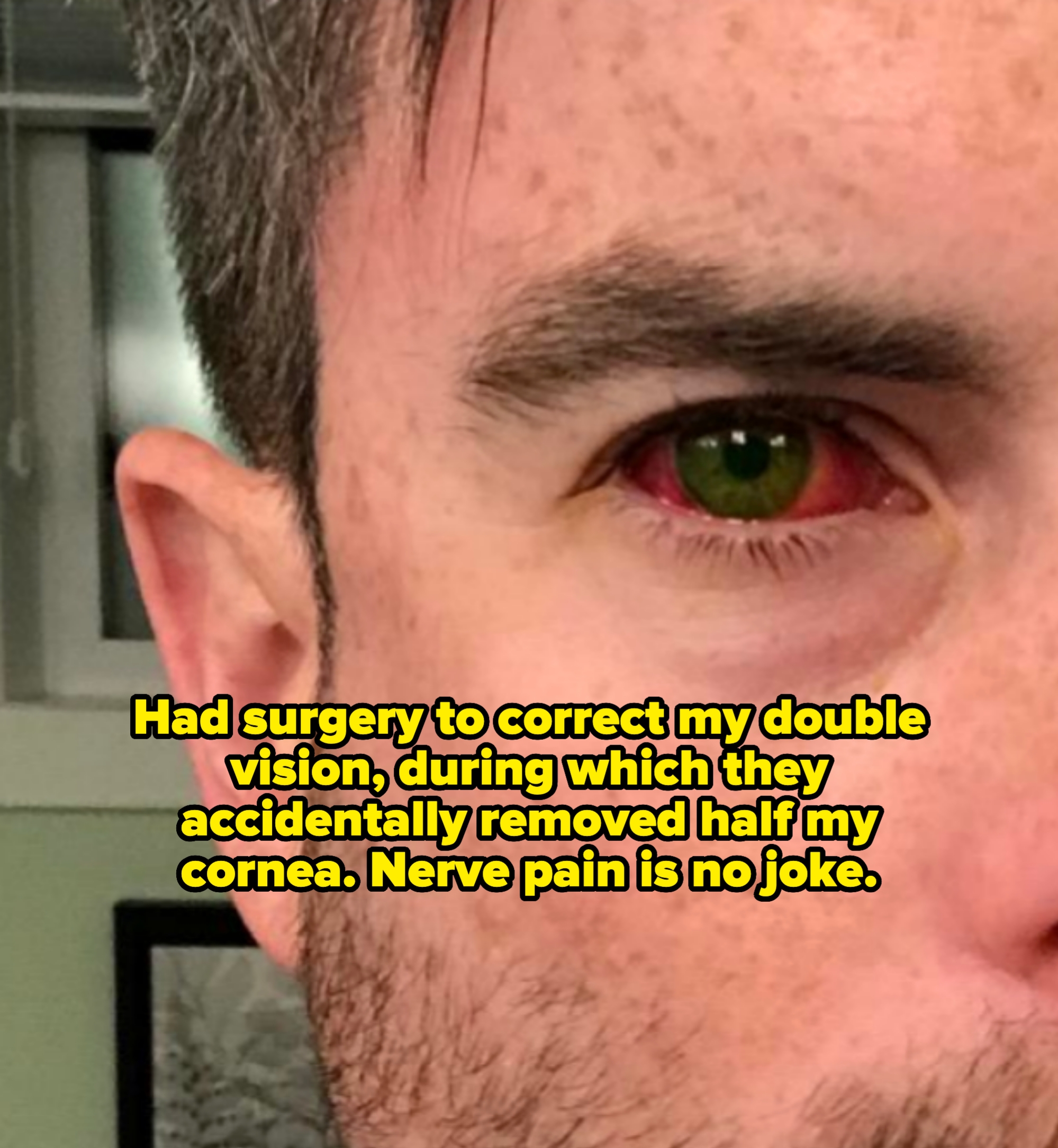 Close-up of half a person's face, focusing on one inflamed red eye. Caption: "Had surgery to correct my double vision, during which they accidentally removed half my cornea. Nerve pain is no joke"
