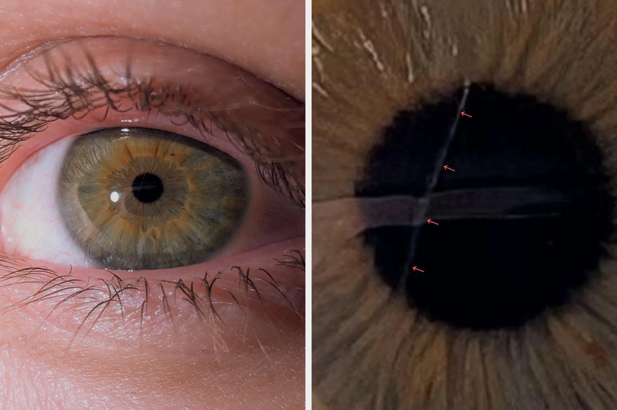 Close-up of an eye on the left and a magnified view of the pupil with a visible scratch on the right