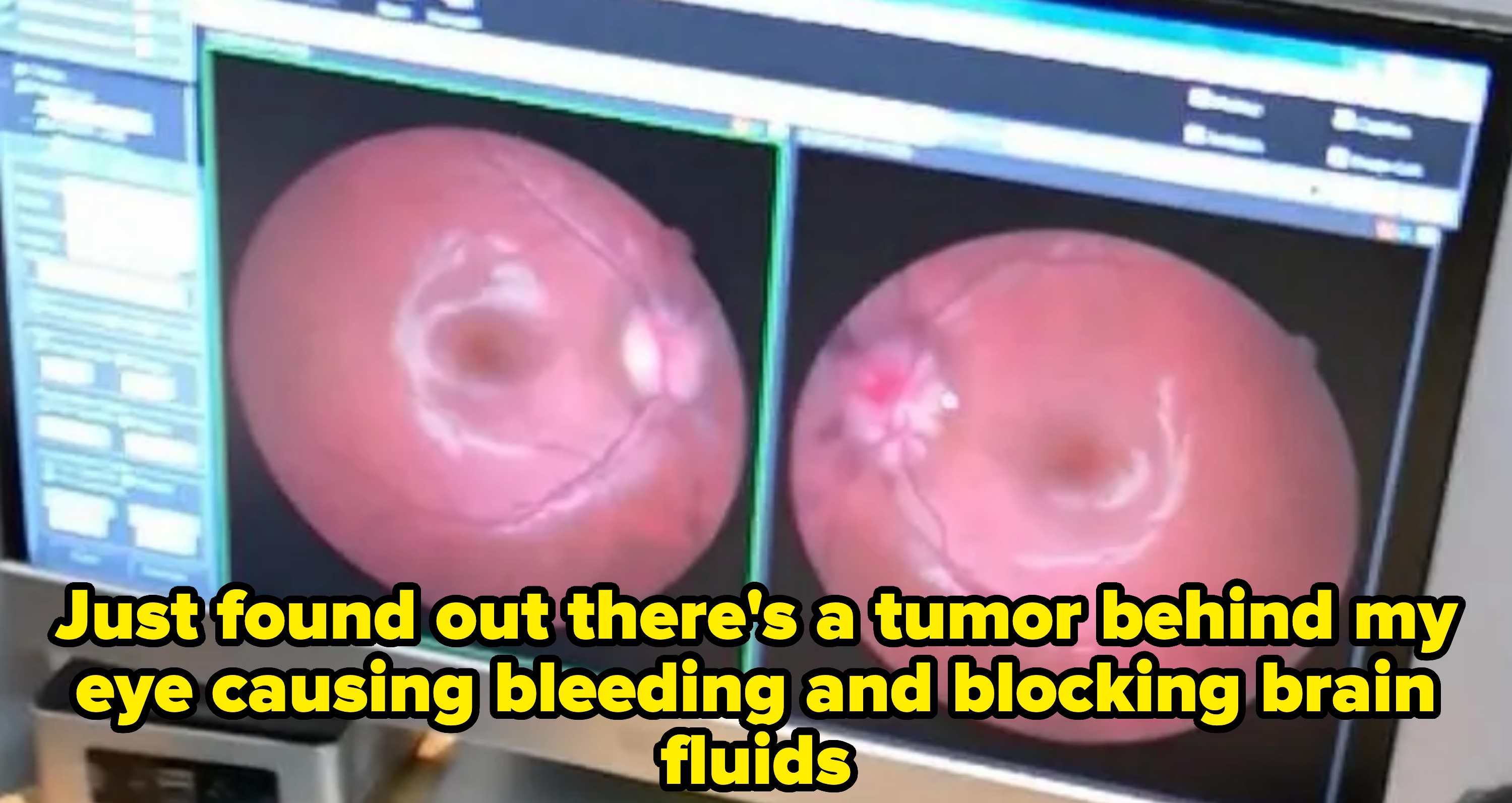 Medical monitor displaying two images of behind the eye. A small mass is visible. Caption: "Just found out there's a tumor behind my eye causing bleeding and blocking brain fluids"