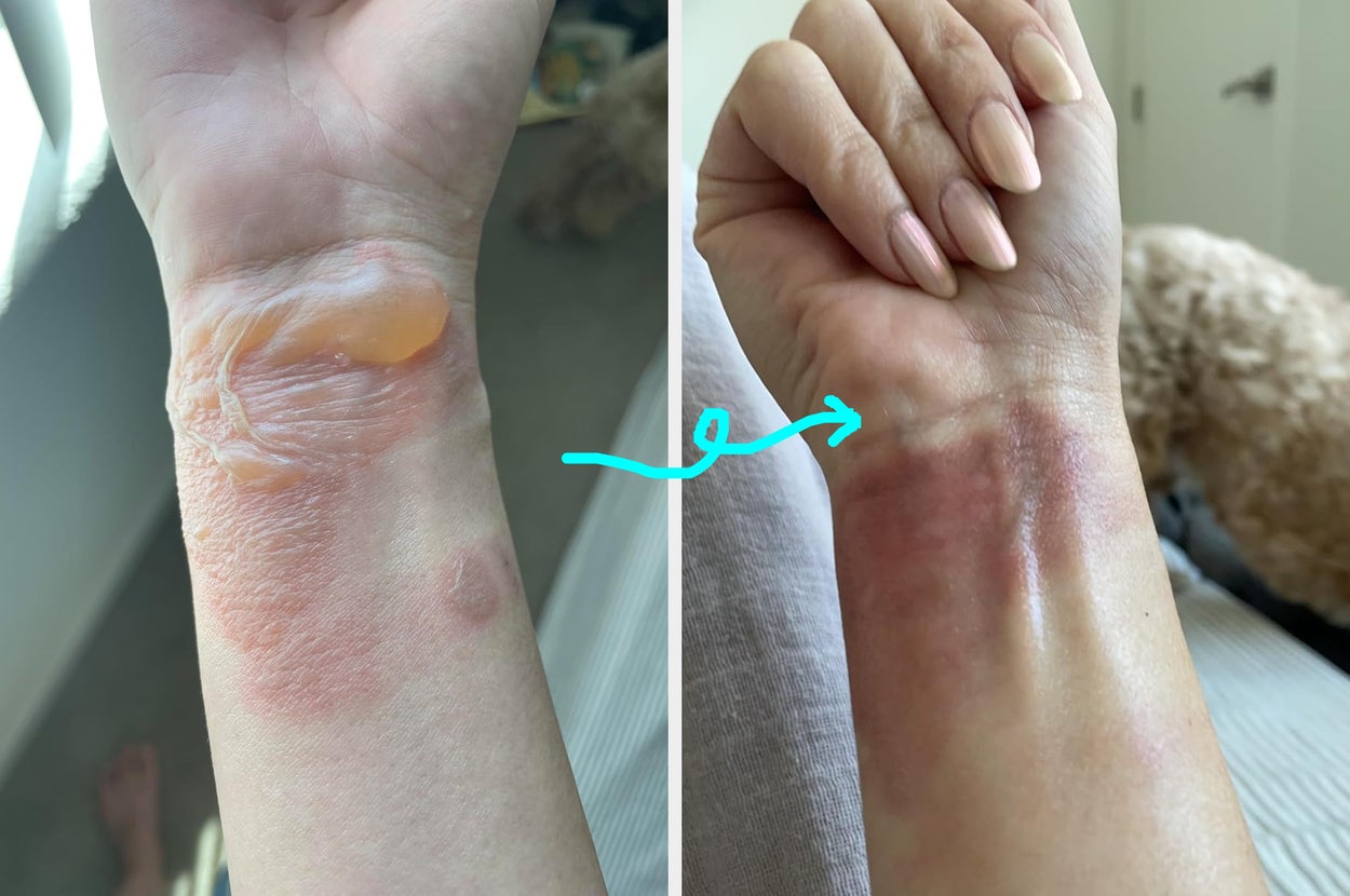 Do *Not* Click This Post If You’re Squeamish: 17 Personal Care Products With Gnarly Before And After Photos - BuzzFeed