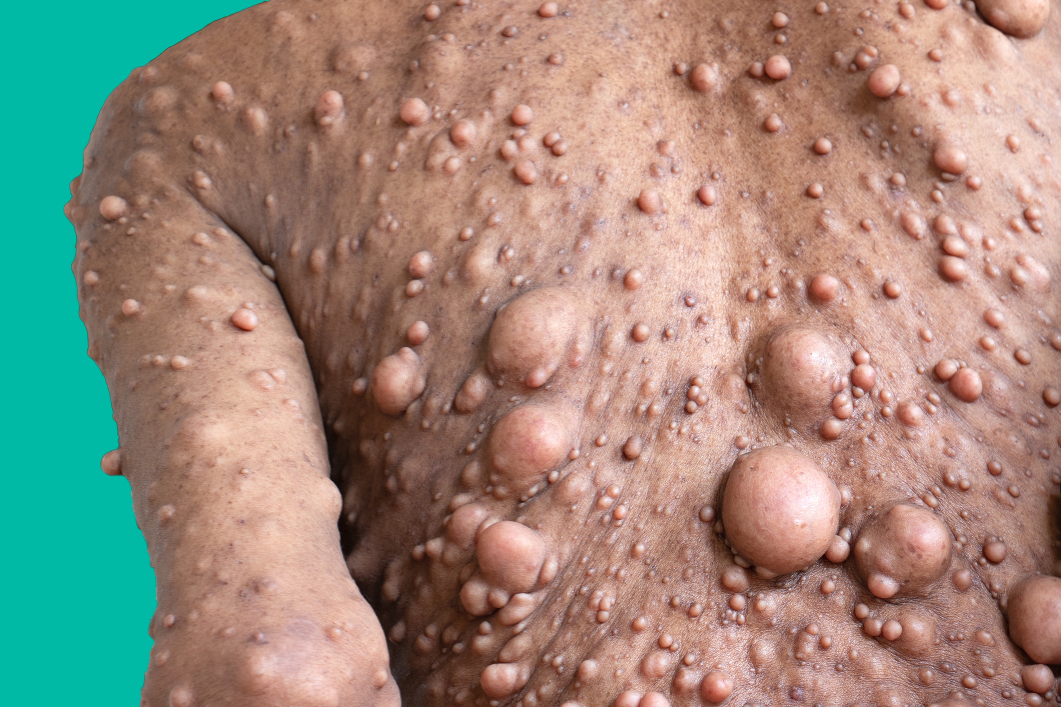 Close-up of a person's torso with multiple raised bumps of varying sizes on their skin