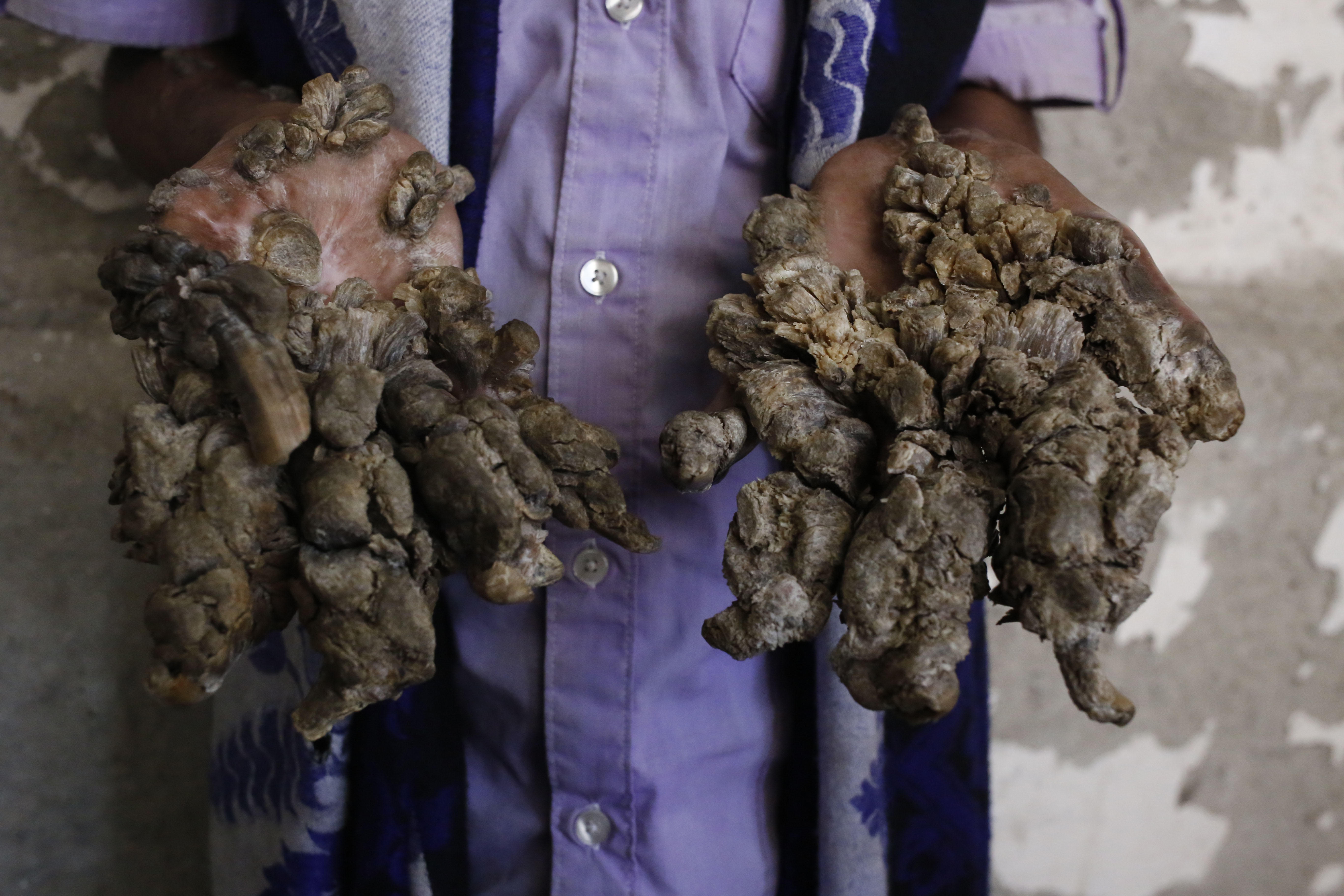 Person with large, unusual growths on their hands, resembling tree bark