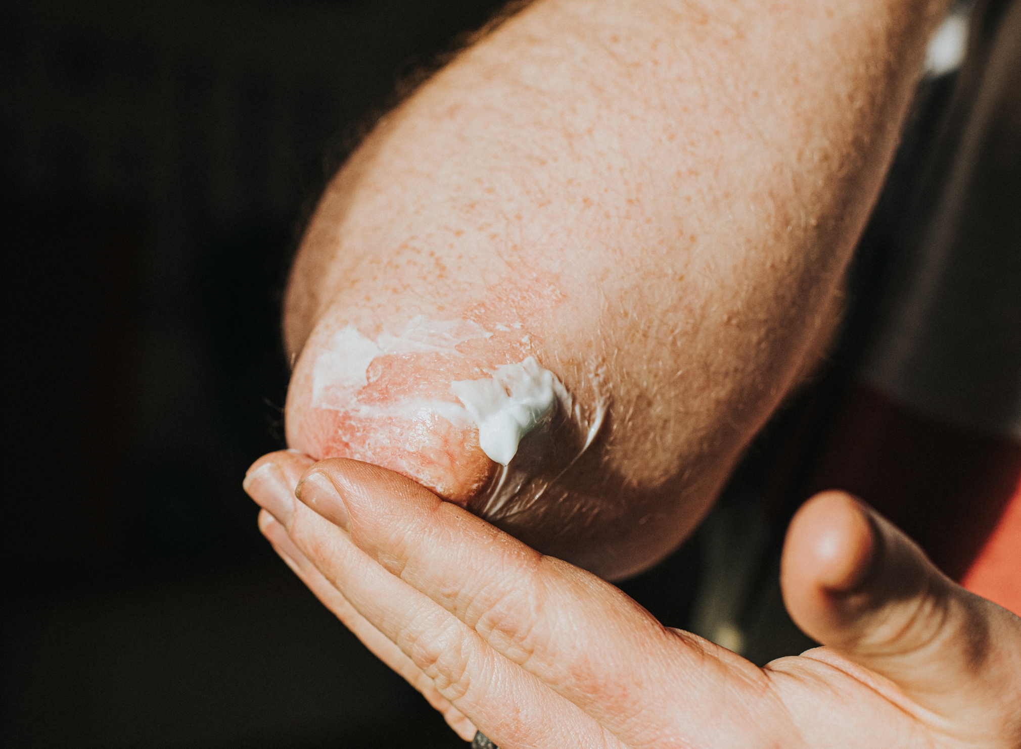 Bruke lotion på en persons tørre albue for fuktighetsgivende pleie
