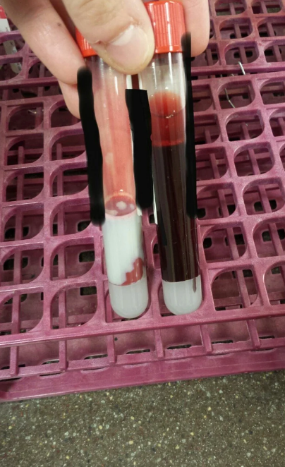 Two test tubes held by a hand, one with a pink and white substance and the other with a normal dark red blood hue