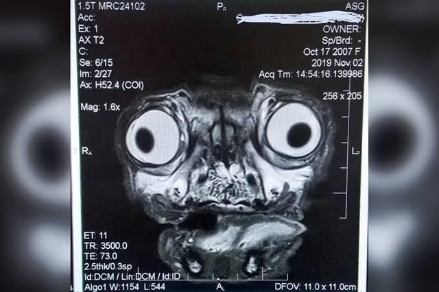 An MRI scan resembling a cartoonish face with wide eyes and a round nose