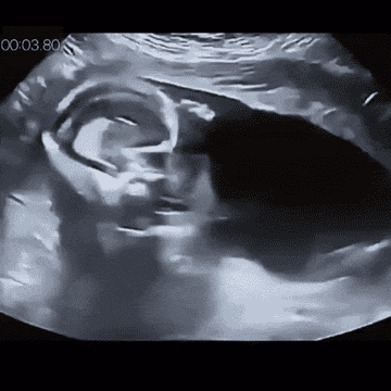 fetus in ultrasound shown kicking rapidly in the womb