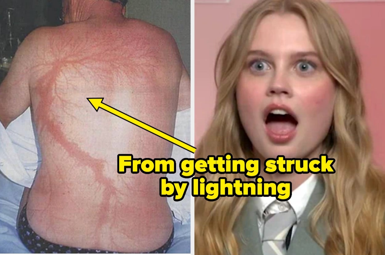 Left: Person with a lightning scar on their back. Right: Person with surprised expression, captioned "From getting struck by lightning"