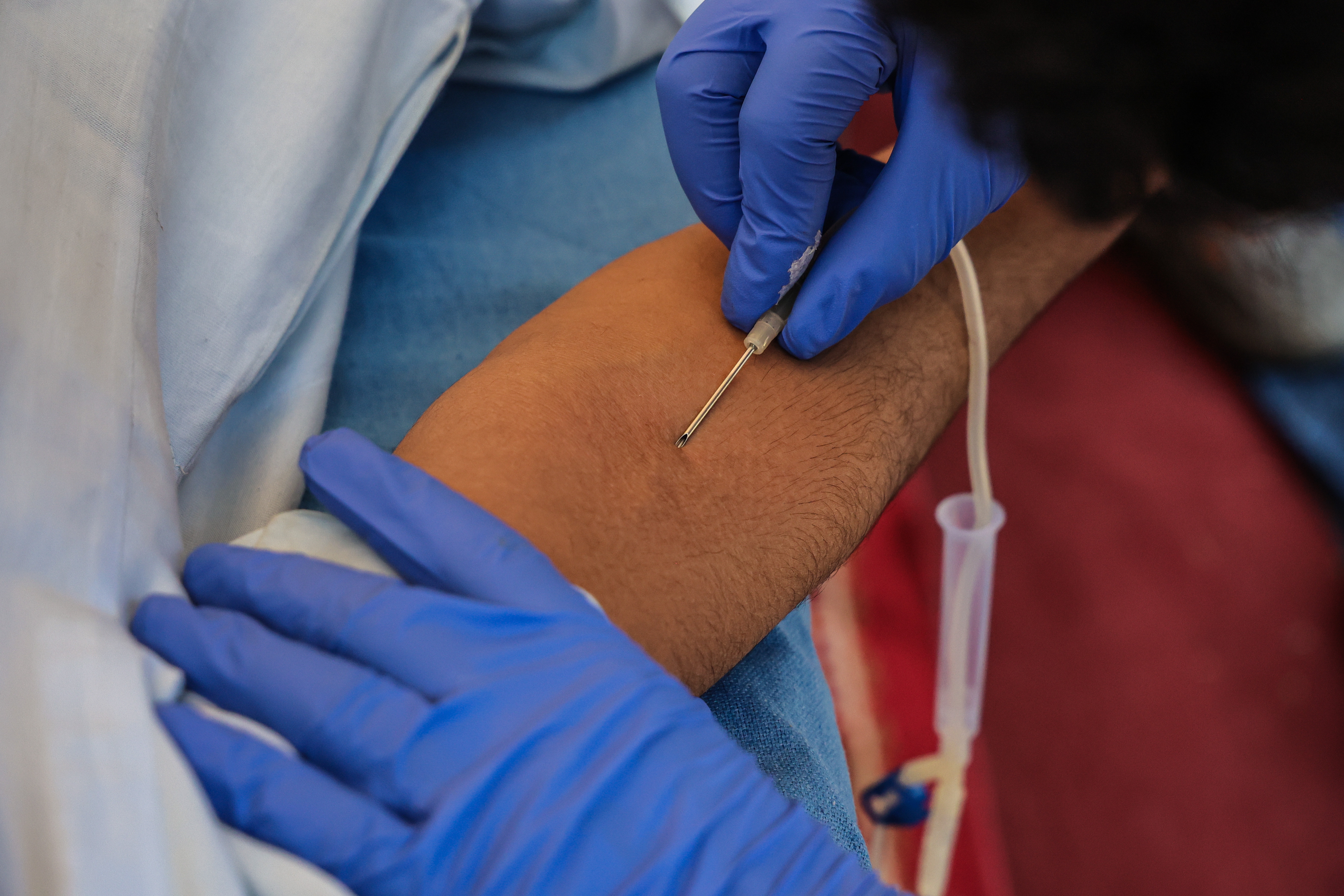 Person receives acupuncture treatment on arm using thin needles. Practitioner wears blue gloves for hygiene