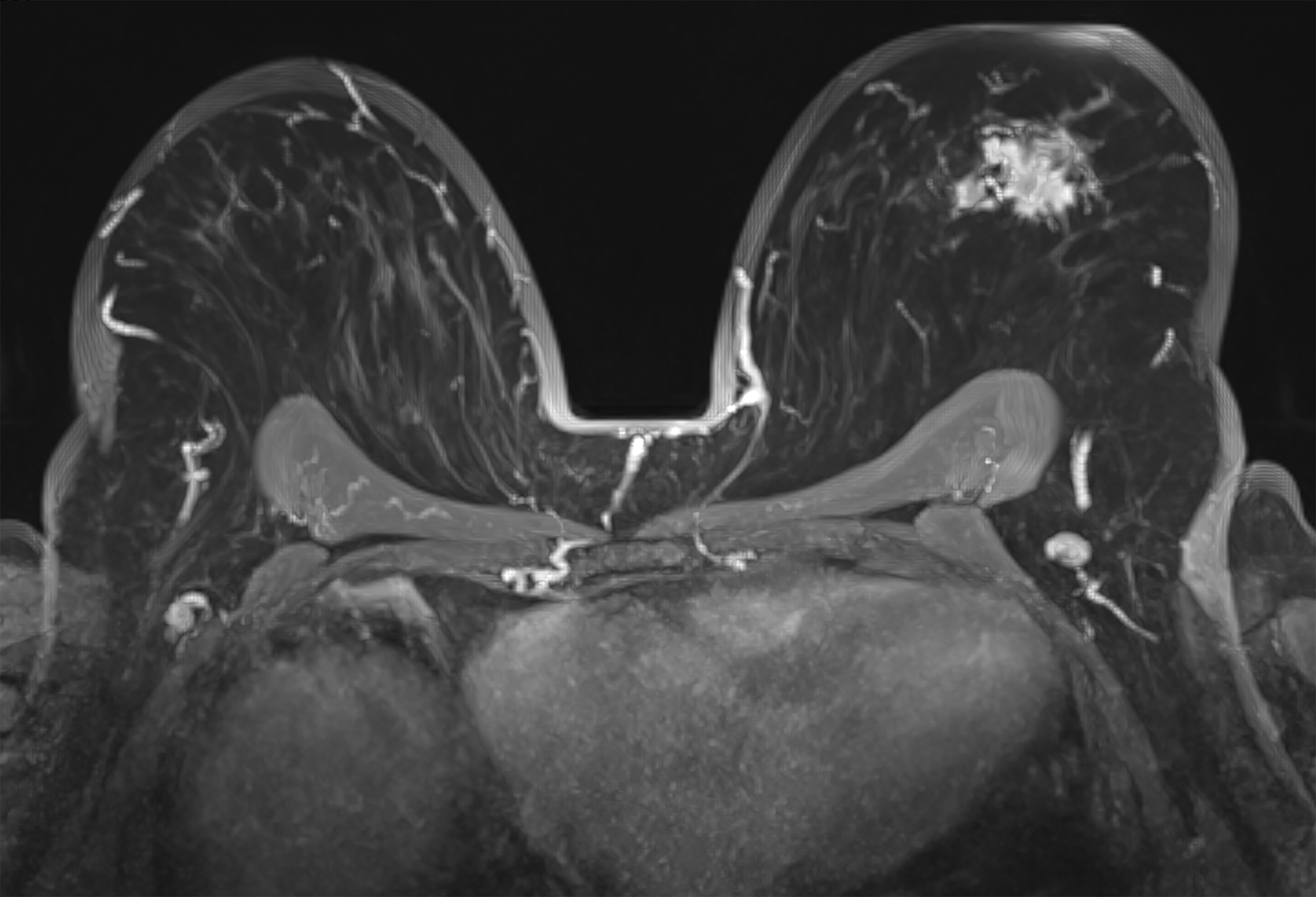 Medical MRI scan showing breast tissue in detailed cross-section