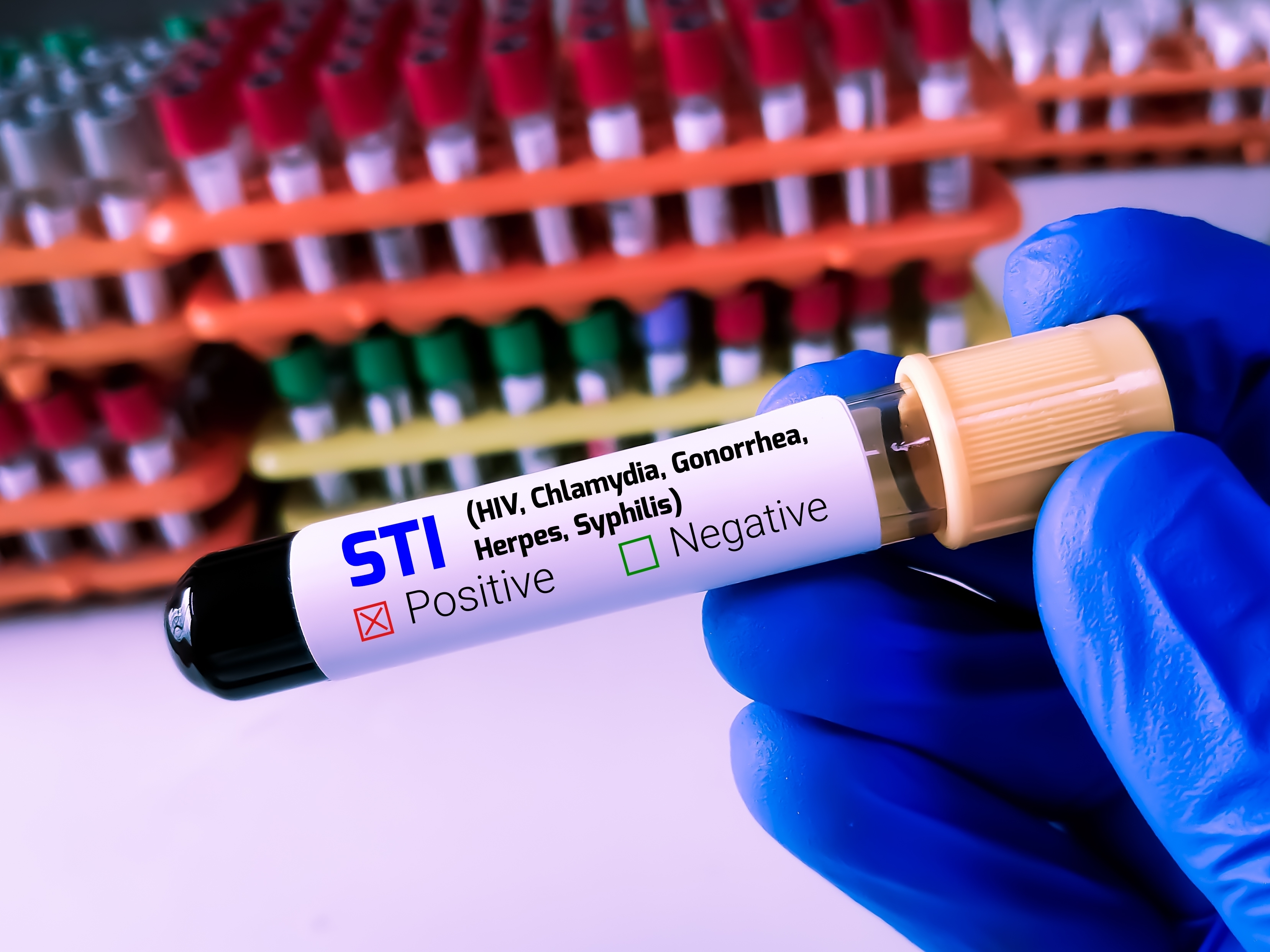 A gloved hand holds a test tube labeled &quot;STI&quot; with checkboxes for positive and negative results, surrounded by rows of test tubes