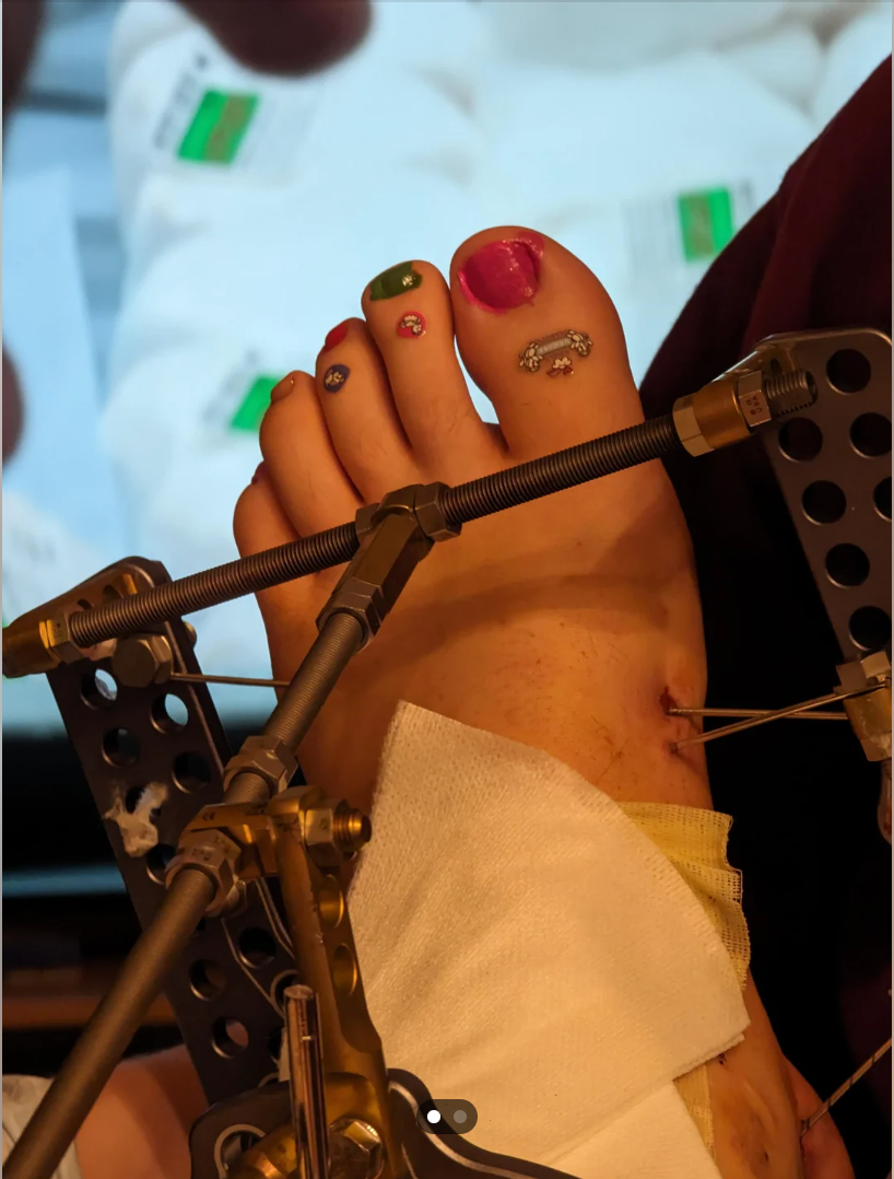 Toe with colorful nail art in a medical brace, possibly after surgery