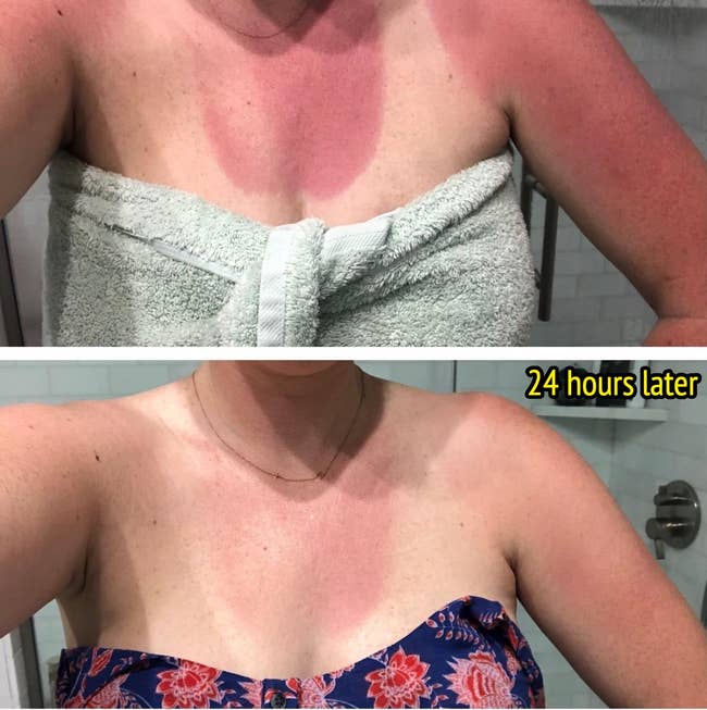 Two images amusement a idiosyncratic with sunburnt shoulders and precocious chest, archetypal successful a towel, past successful a strapless top, highlighting severity and signifier of the burn