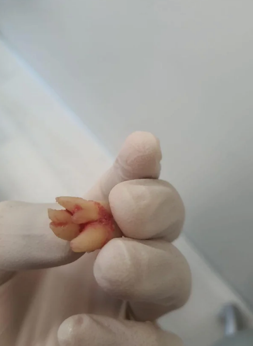 Gloved hand holding a recently extracted tooth with multiple roots, against a neutral background