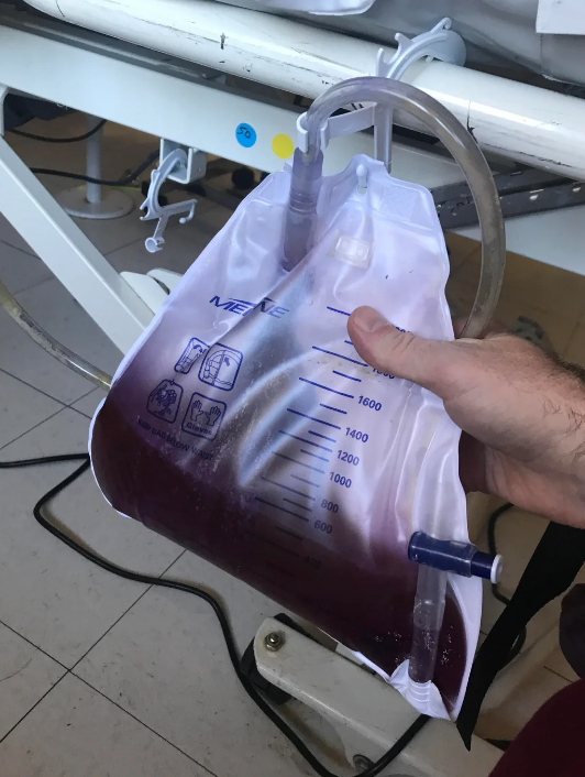 A hand holds a medical drainage bag filled with dark liquid and attached to tubing, situated next to hospital equipment