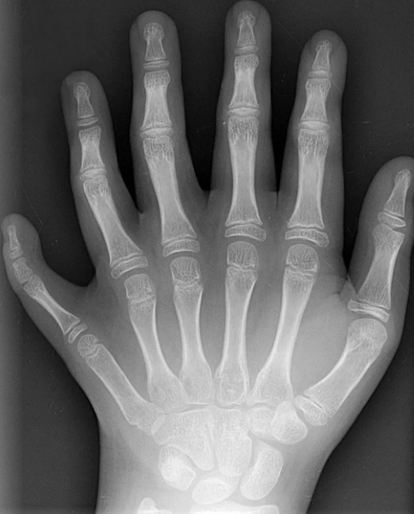X-ray image of a left hand showing bones and joints clearly visible, with each finger fully extended
