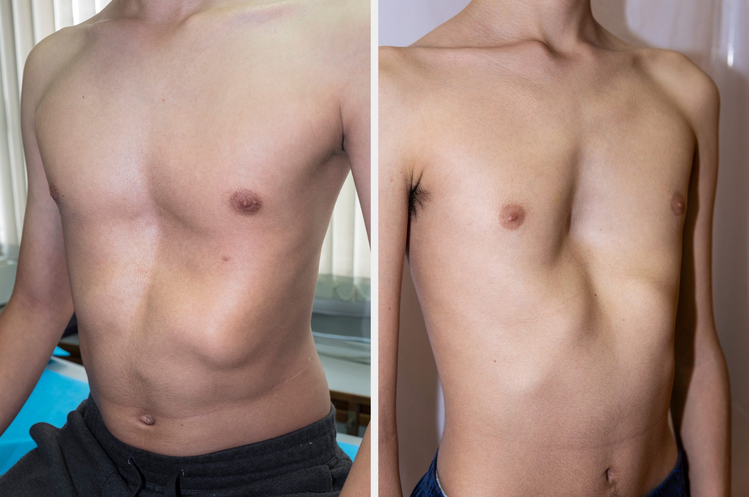 Two photos show torsos with pectus excavatum, depicting sunken chest appearances in side-by-side comparison