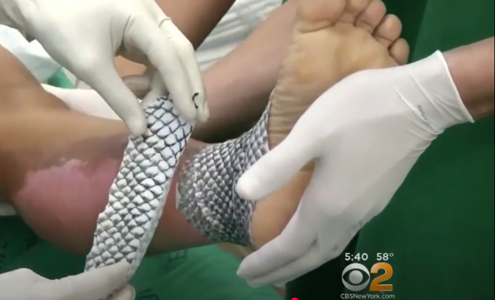 Fish skin bandage is applied to a person's foot by gloved hands, used as an innovative skin treatment