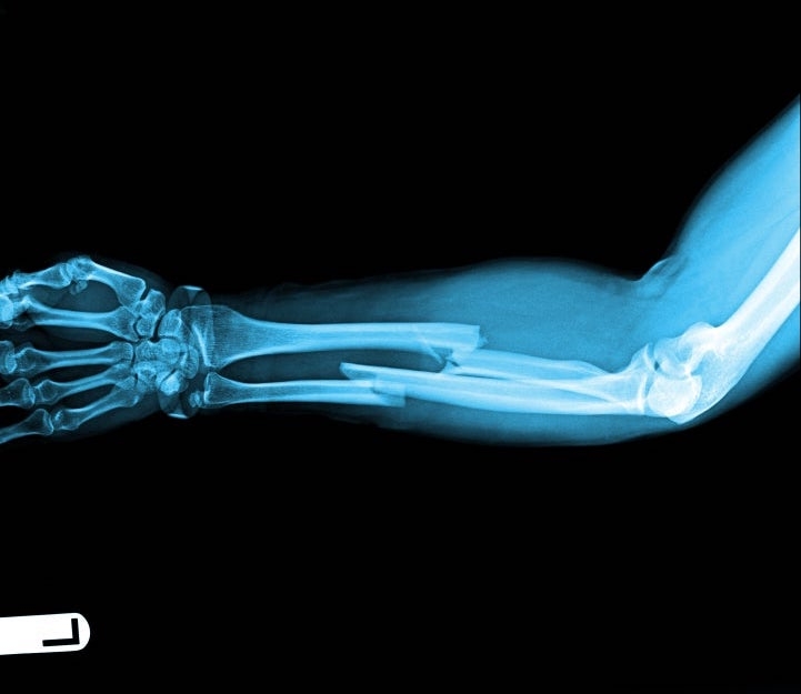 X-ray of a human forearm showing a clear fracture in the middle of the radius and ulna bones