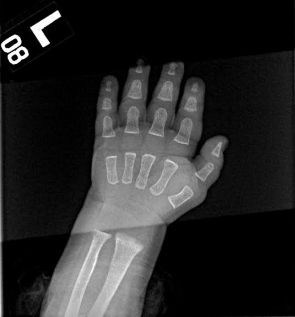X-ray of a human hand displaying bones and joints, showing skeletal structure details, with numbered corner marker indicating medical context