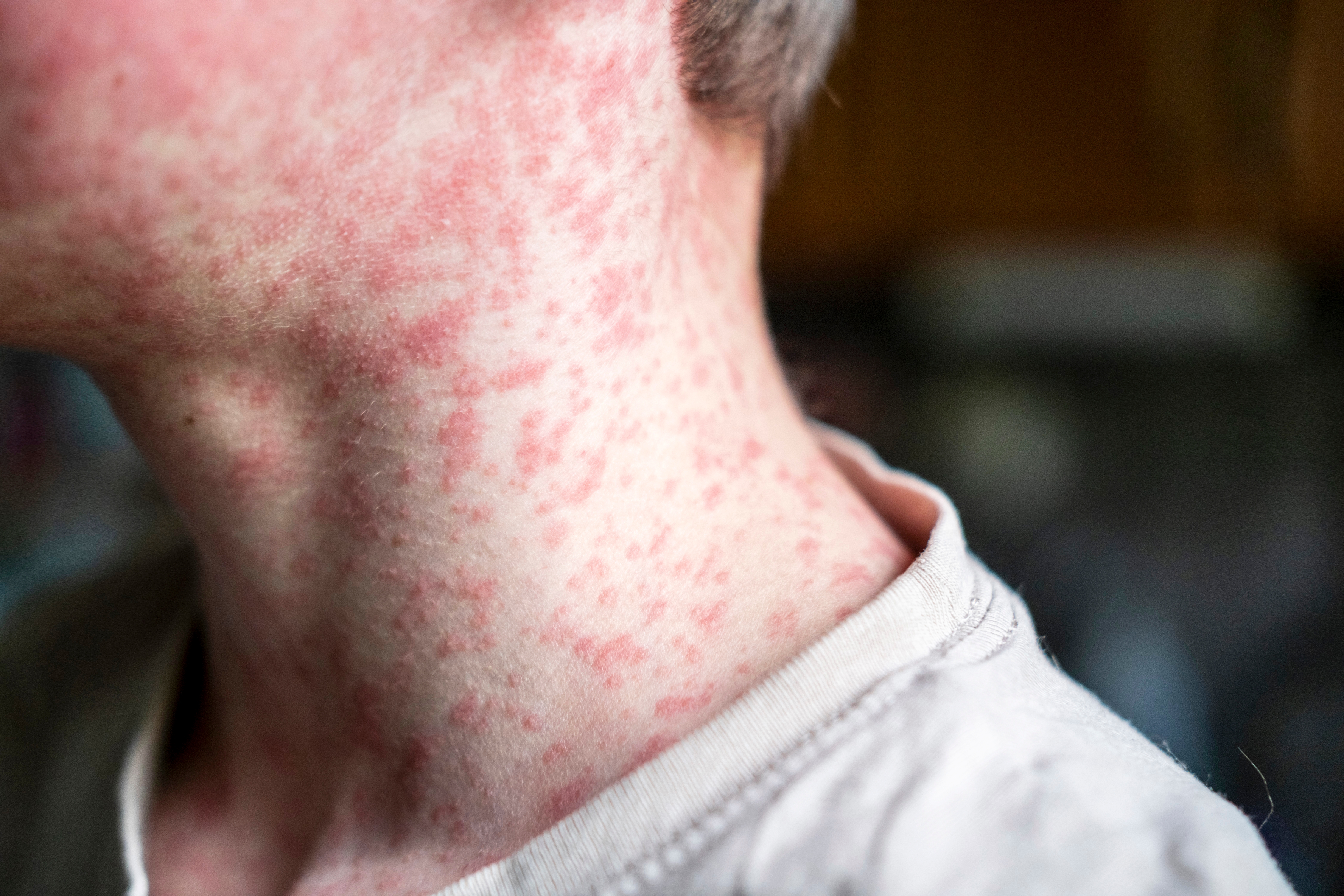 A close-up of a person's neck with a visible rash covering the skin