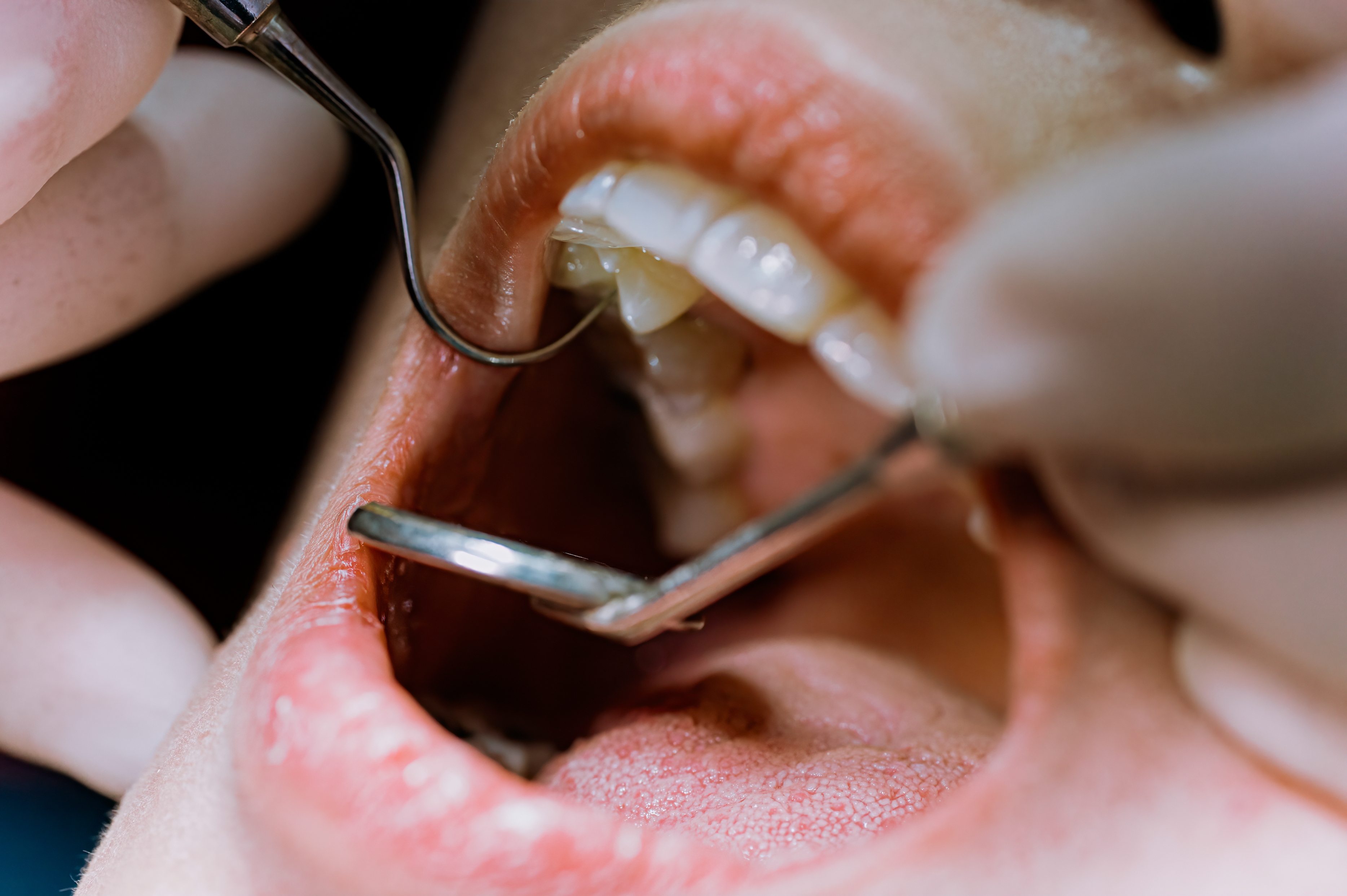 Dentist examining a patient's open mouth with dental tools