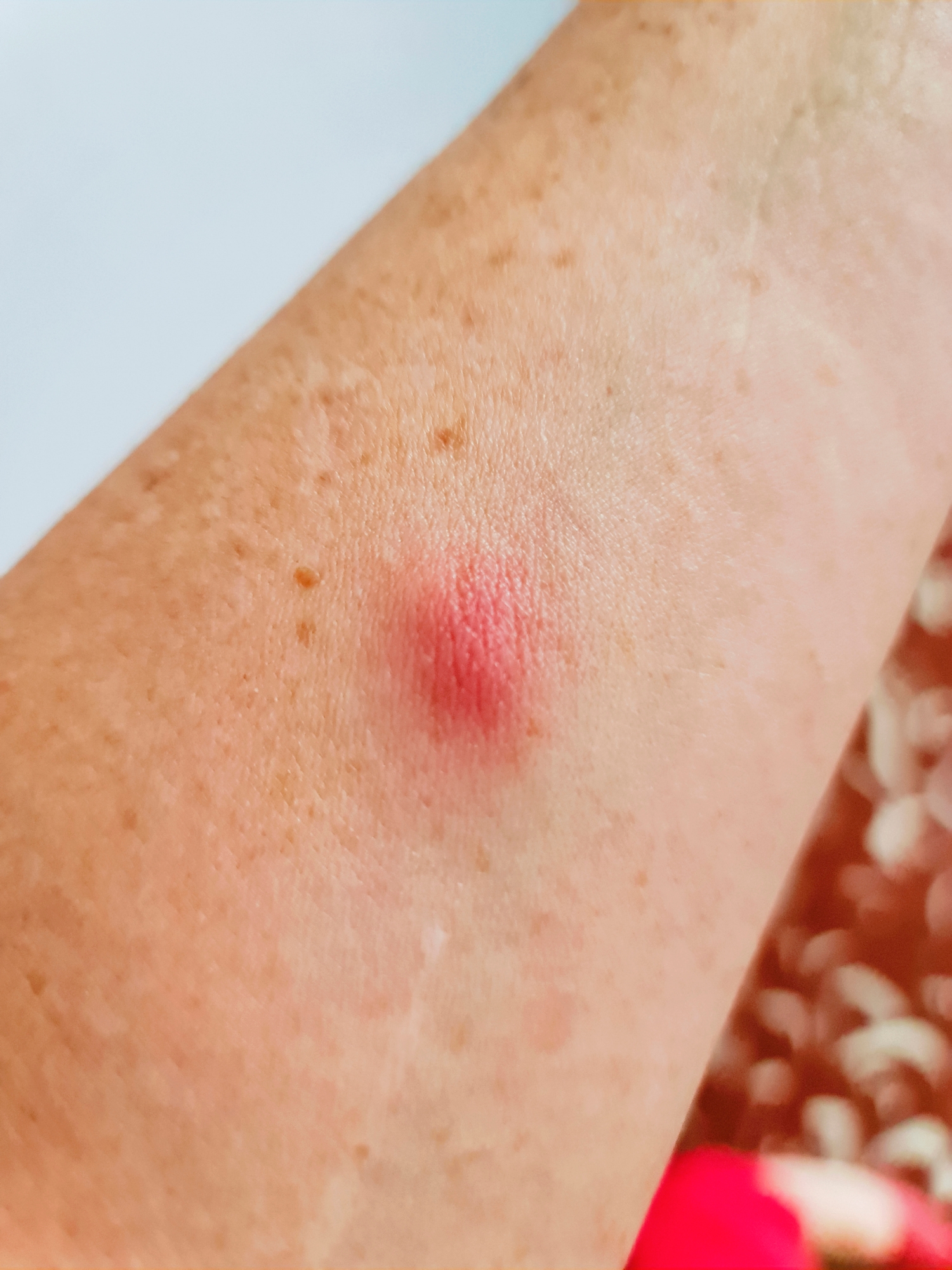 Nærbilde av en arm med en liten, hevet rød støt, muligens et insektbitt eller irritasjon, på huden