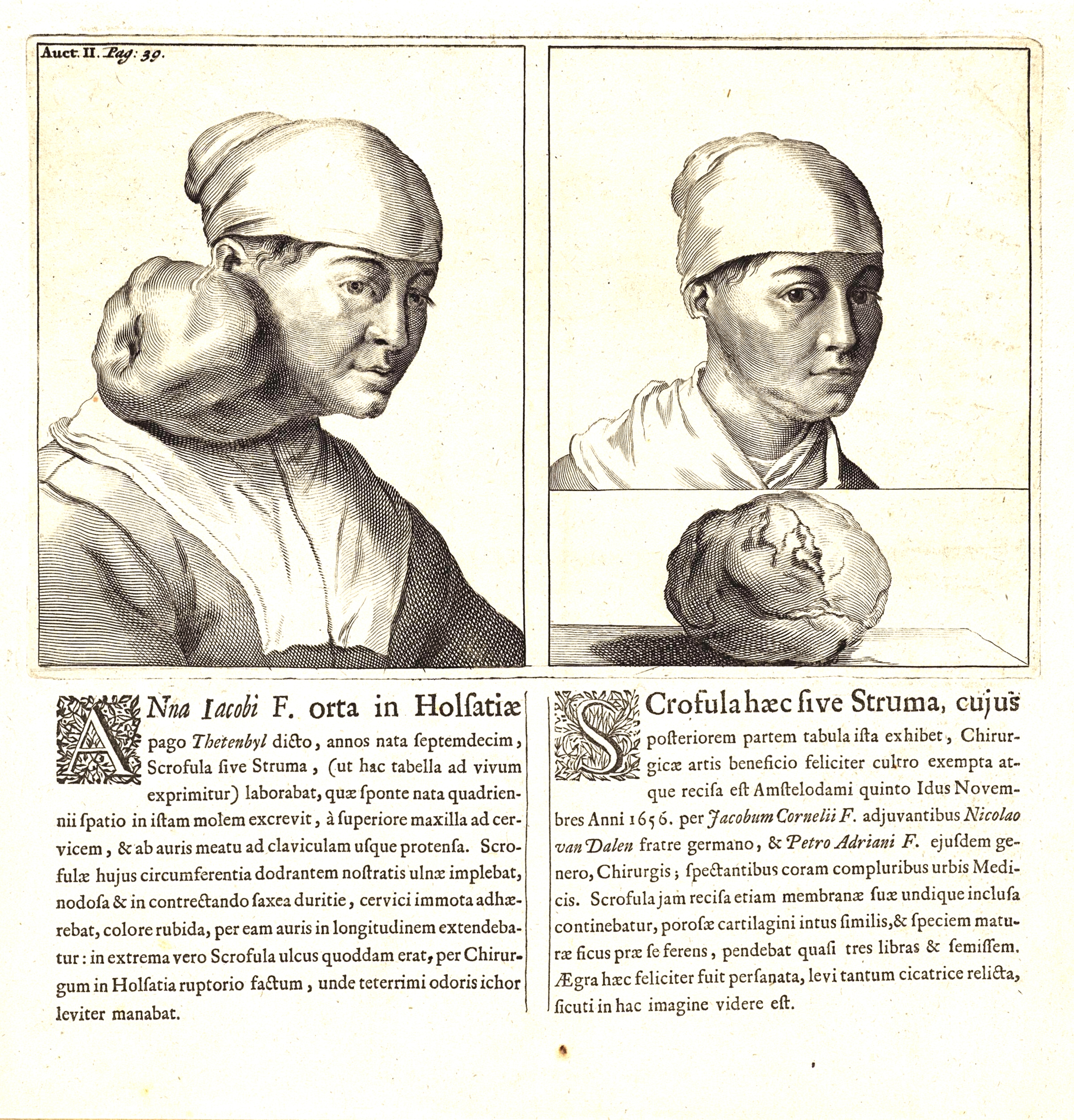 Two detailed medical illustrations of a woman with swellings on her neck, accompanied by explanatory text about a historical medical condition